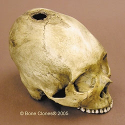 Human Female Trephinated Skull (Bolivian) 