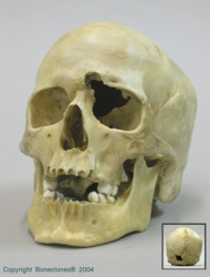 Human Gunshot-wound Skull (European Male, 32-caliber bullet hole)