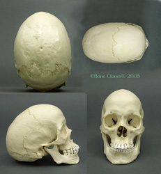 Human Scaphocephalic Skull (Female)