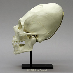 Human Male Elongated, Trephinated Skull with Jaw