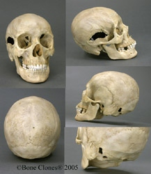 Human Female Skull, 22 caliber bullet holes