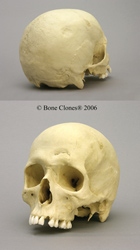 Human Male European Skull, hammer blows