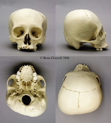 Human Cradle Boarding Skull, possibly Microcephalic