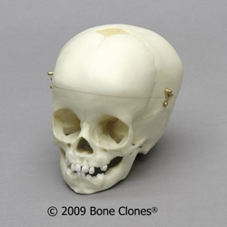 Human Child Skull 1-year-old (12-18 months), Calvarium Cut