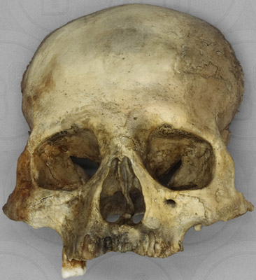Human Female Partial Skull with Cribra Orbitalia, MOM 1915-2-142