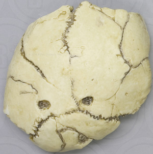 Australopithecus robustus cranium. SK-54 Swartkrans specimen bearing the leopard canine punctures