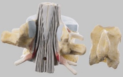 Lumbar Vertebra (L II) with Lumbar Region of Spinal Cord
