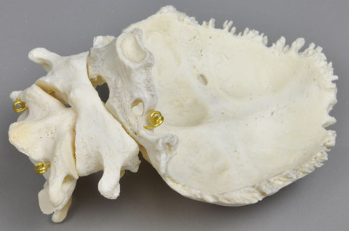 Atlas, Axis and Squamous Part of the Occipital Bone