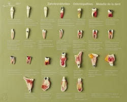 Case of Teeth “Odontopathies”