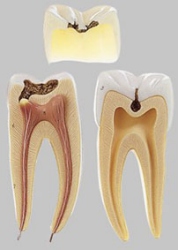 Molar Tooth with Caries