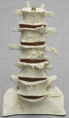 Lumbar Vertebra Display Set of 5 (Arthritic) on stand