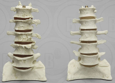 Comparative Lumbar Vertebrae Display, Normative and Arthritic on Stand 