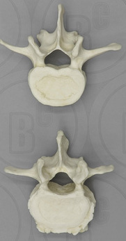 Comparative Lumbar (L-3) Vertebra Set of 2 (Arthritic and Normal)