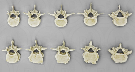 Comparative Human Lumbar Vertebrae Set, 5 normal and 5 arthritic