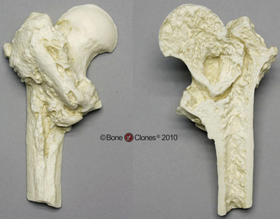 Femoric Hip fracture- sectioned