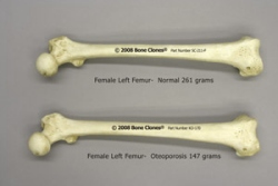 Femur with Osteoporosis and Normal Femur