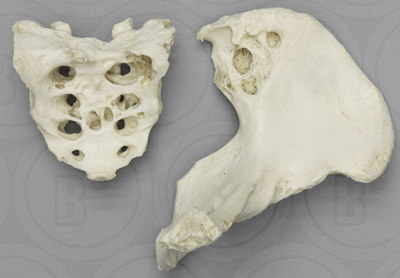 Human Pathology, Tuberculosis, Innominate and sacrum