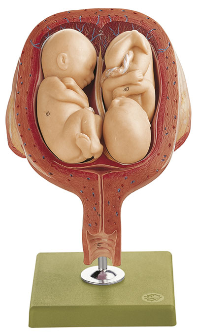 Uterus mit Zwillingsfeten im 5. Monat