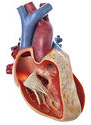 Fallot’s Tetralogy