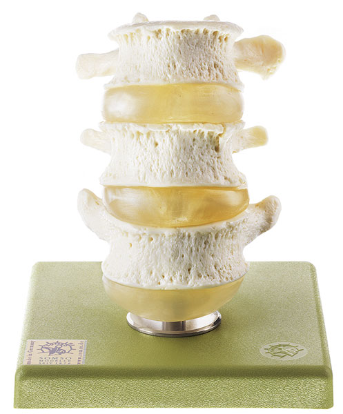 Three Lumbar Vertebrae with Discs