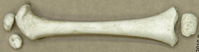 Femur & Epicondyle (5) (R or L) 14-16-month-old Child